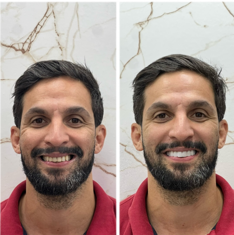 Antes e Depois - Transformação 1